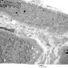 3C7A Inclusions, dermatomyositis (Case 3) 015A - Copy