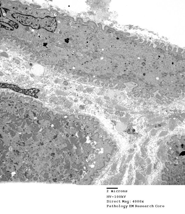 3C7A Inclusions, dermatomyositis (Case 3) 015A - Copy