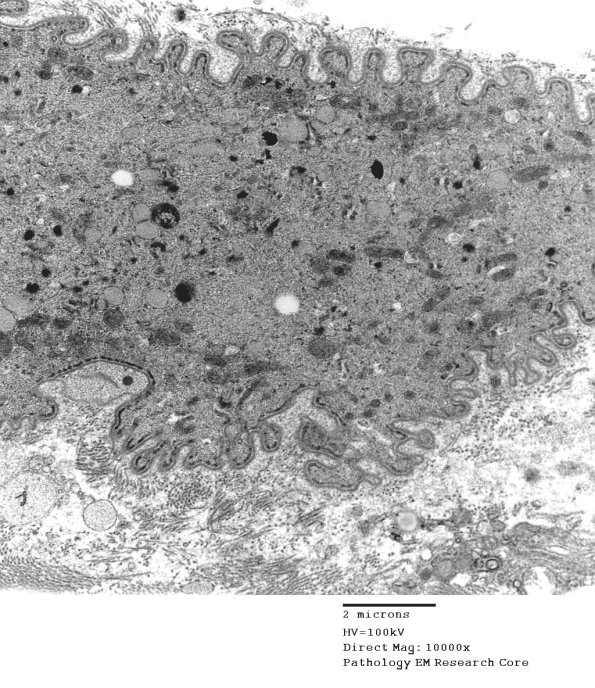 3C7B Inclusions,dermatomyositis (Case 3) 017A - Copy
