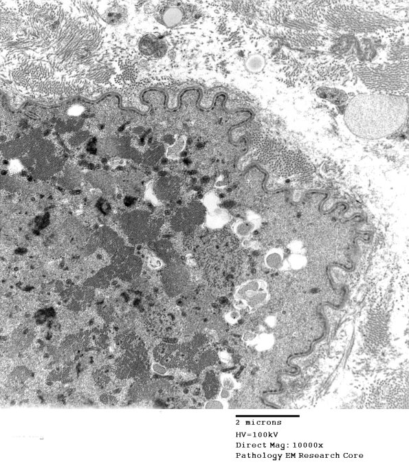 3C7C Inclusions,dermatomyositis (Case 3) 016A - Copy