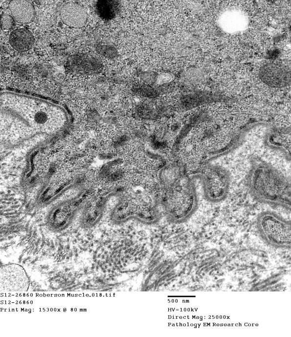 3C7D Inclusions,dermatomyositis (Case 3) 018A - Copy