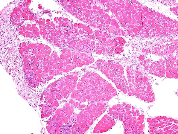 4A1-Dermatomyositis-Case-4-CD3-H-E-10.jpg