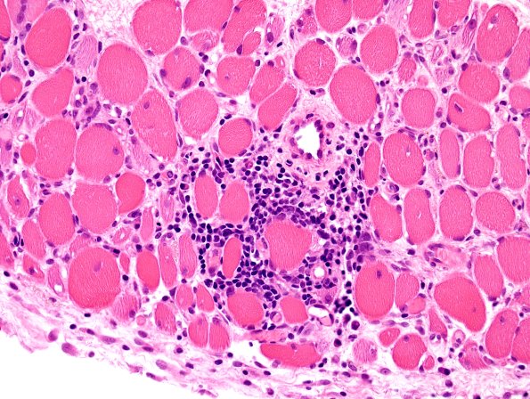 4A3-Dermatomyositis-Case-4-CD3-H-E-4.jpg