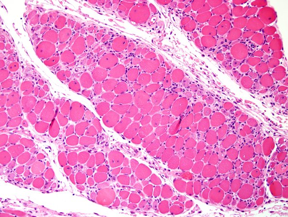 4A4-Dermatomyositis-Case-4-CD3-H-E-7.jpg