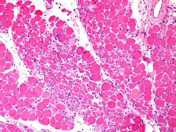 4A5-Dermatomyositis-Case-4-CD3-H-E-9.jpg