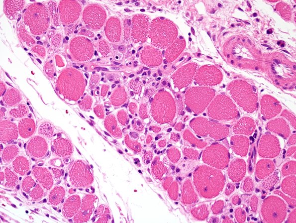 4A6-Dermatomyositis-Case-4-CD3-H-E-2.jpg