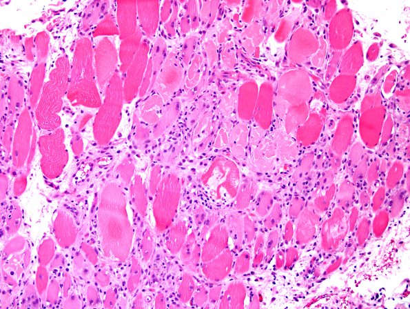 4A7A-Dermatomyositis-Case-4-CD3-H-E-5.jpg