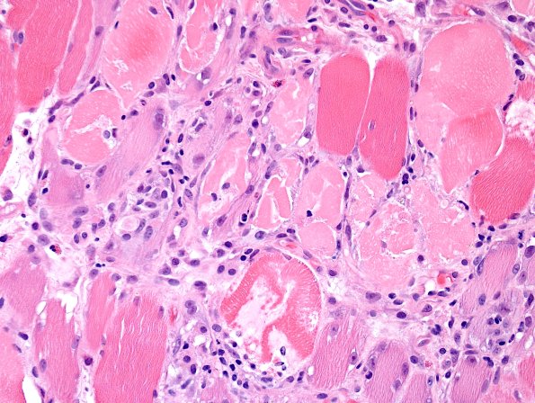 4A7B-Dermatomyositis-Case-4-CD3-H-E-1.jpg