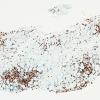 4C1-Dermatomyositis-Case-4-CD3-3.jpg