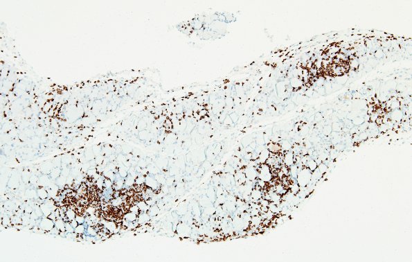 4C1-Dermatomyositis-Case-4-CD3-3.jpg