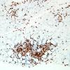 4C2-Dermatomyositis-Case-4-CD3-2.jpg