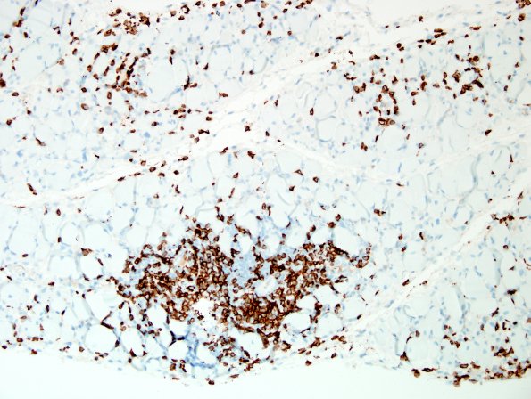 4C2-Dermatomyositis-Case-4-CD3-2.jpg