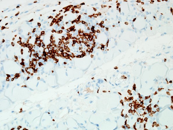 4C3Dermatomyositis-Case-4-CD3-1.jpg