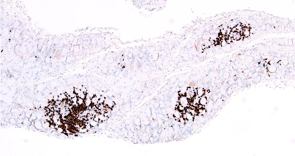 4D1-Dermatomyositis-Case-4-CD20-4.jpg