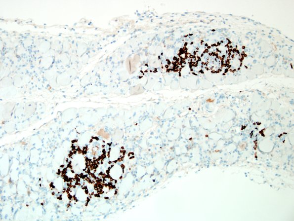 4D2Dermatomyositis-Case-4-CD20-2.jpg