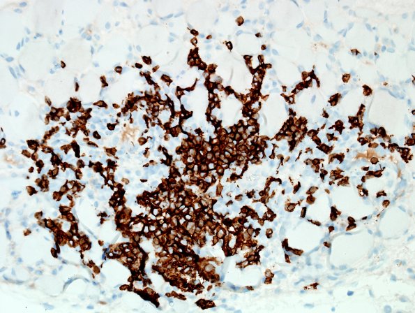 4D3-Dermatomyositis-Case-4-CD20-3.jpg
