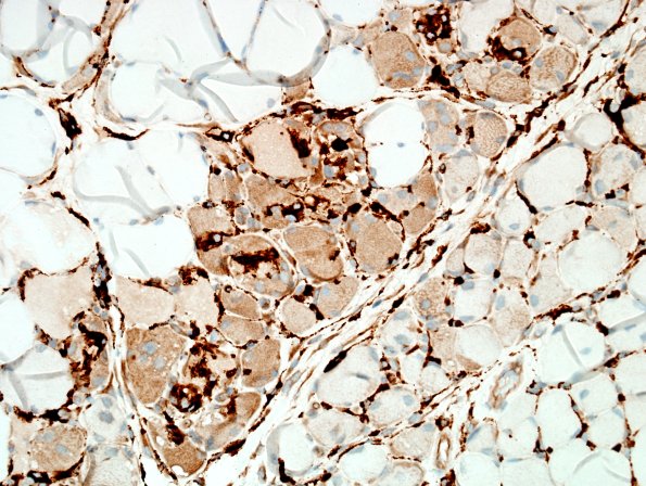 4E2A-Dermatomyositis-Case-4-CD68-1.jpg