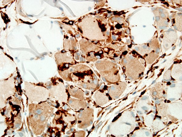 4E2B-Dermatomyositis-Case-4-CD68-7.jpg