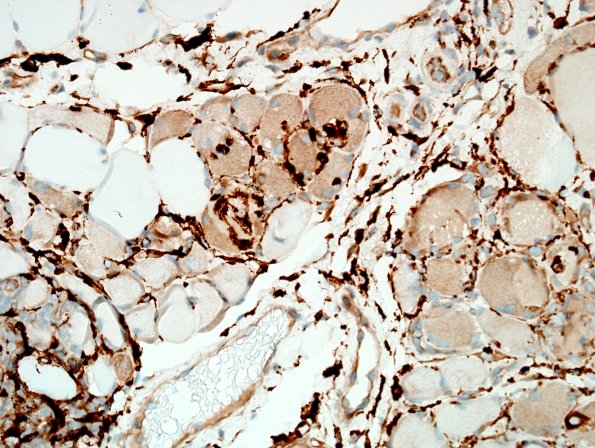 4E3A-Dermatomyositis-Case-4-CD68-4.jpg