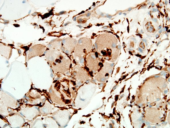 4E3B-Dermatomyositis-Case-4-CD68-5.jpg