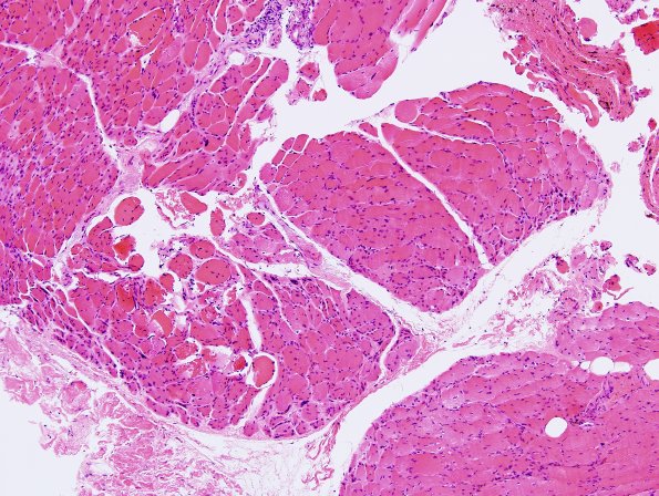 5A3 Dermatomyositis (Case 5) H&E 3