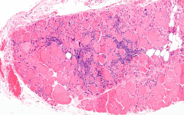 7A1 perifascicular atrophy (Case 7A) H&E 2
