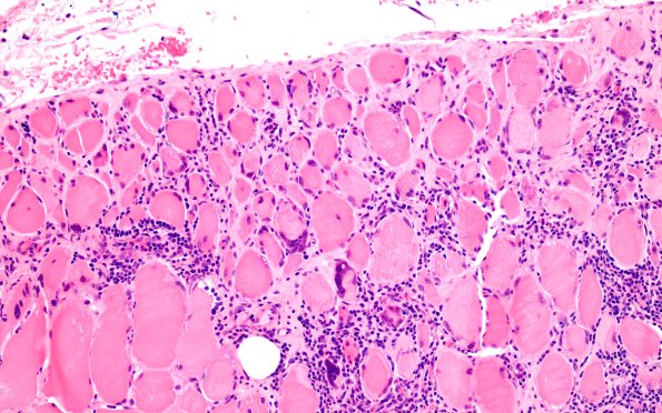 7A2 perifascicular atrophy (Case 7A) H&E 1