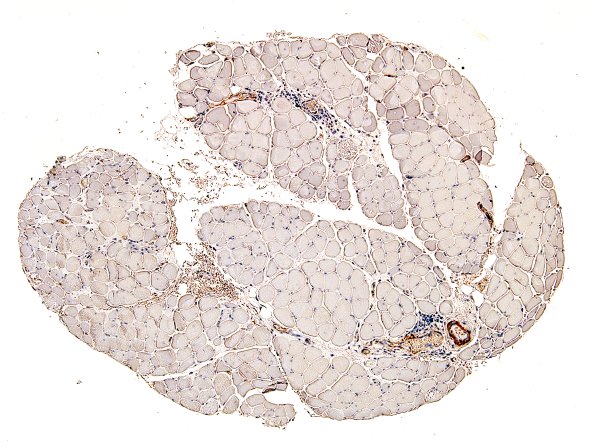7C2 Dermatomyositis (Case 7C) SMA