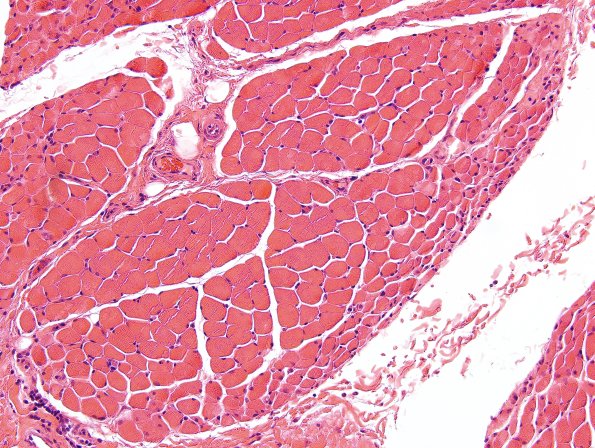 7D Dermatomyositis (Case 7D)