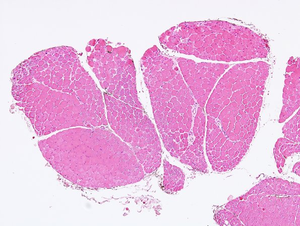 7E1 Dermatomyositis (Case 7E) H&E 3