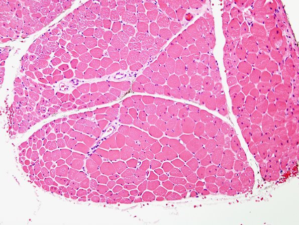 7E2 Dermatomyositis (Case 7E) H&E 2