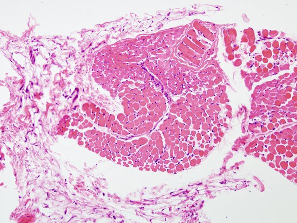 7F1 Dermatomyositis (Case 7F) H&E 2