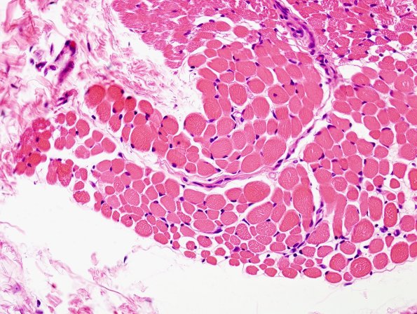 7F2 Dermatomyositis (Case 7F) H&E 1