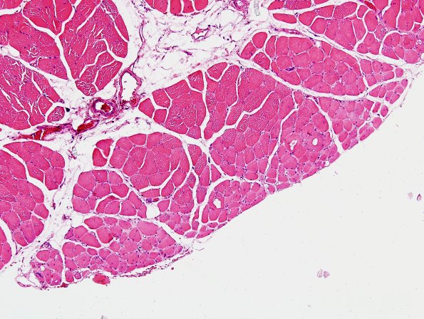 7G1 Atrophy, perifascicular Case 7G) H&E 1