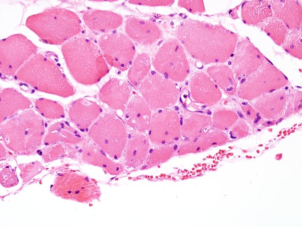 7G2 Atrophy, perifascicular (Case 7G) H&E 2