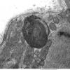 1A3 Hydroxychloroquine Toxicity, Heart (Case 1) EM 014 - Copy