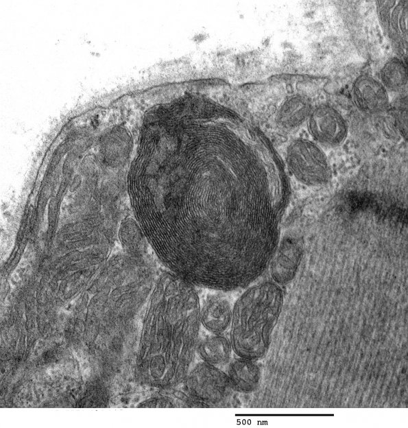 1A3 Hydroxychloroquine Toxicity, Heart (Case 1) EM 014 - Copy