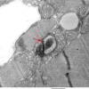 1A4 Hydroxychloroquine Toxicity, Heart (Case 1) EM 011 copy - Copy