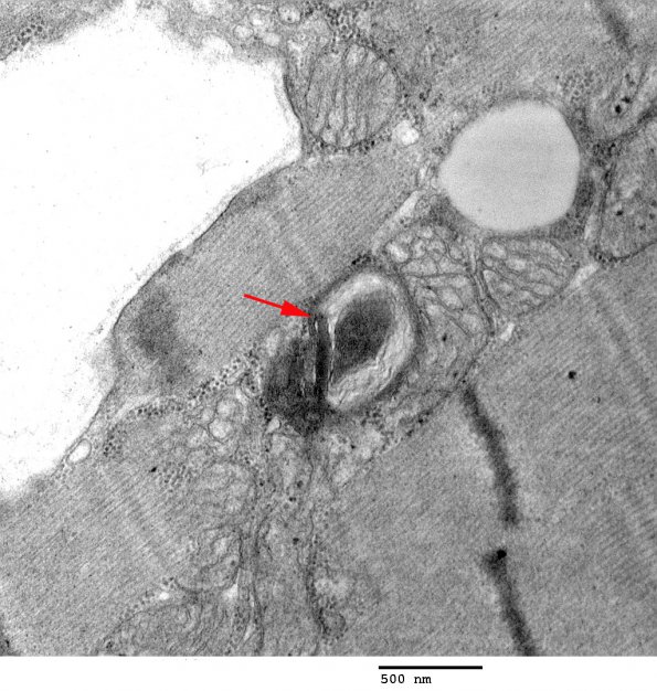 1A4 Hydroxychloroquine Toxicity, Heart (Case 1) EM 011 copy - Copy