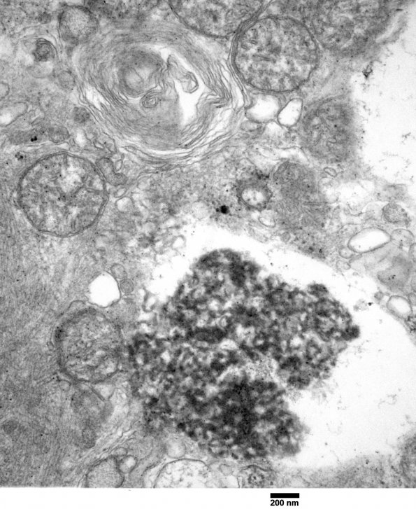 2A2 Hydroxychloroquine, muscle (Case 2) EM 026 - Copy - Copy