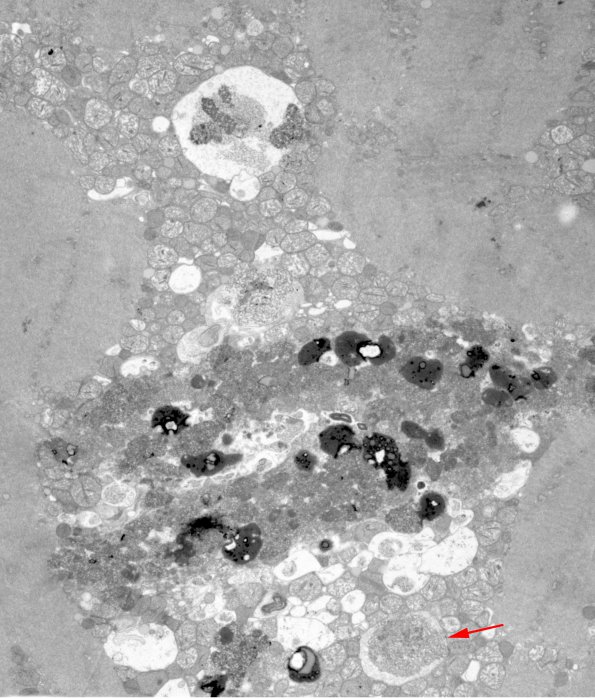 2B1 Hydroxychloroquine, muscle (Case 2) EM 036 copy - Copy