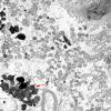 2C1 Hydroxychloroquine, muscle (Case 2) EM 043 copy - Copy