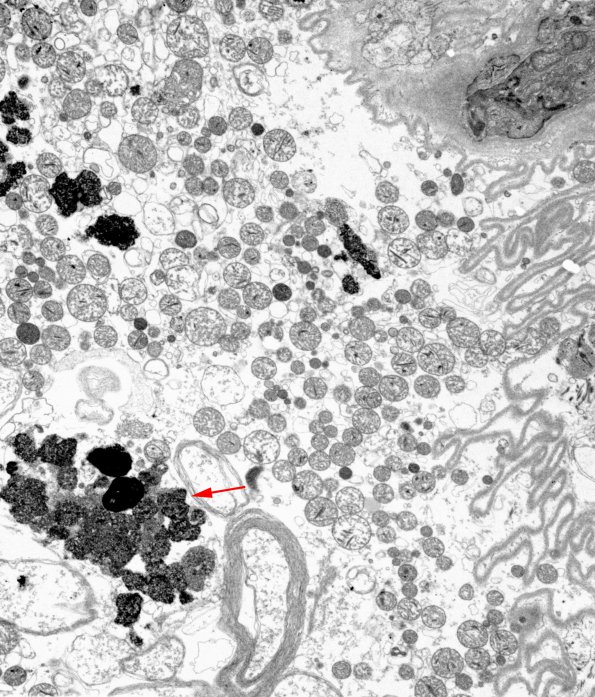 2C1 Hydroxychloroquine, muscle (Case 2) EM 043 copy - Copy