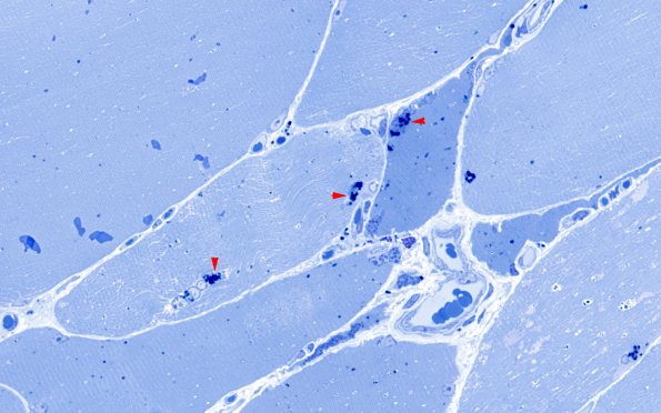 3A1 Hydroxychloroquine, muscle (Case 3) Plastic 3 copy