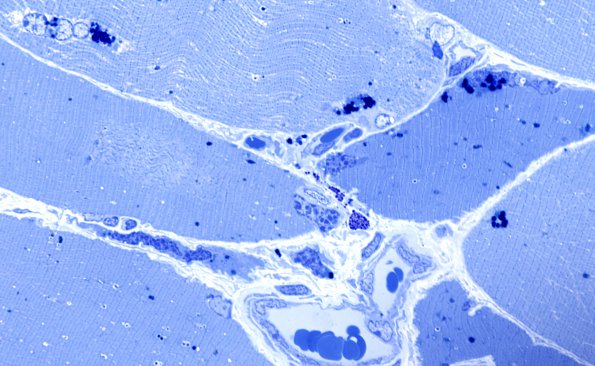 3A2 Hydroxychloroquine, muscle (Case 3) Plastic 6 - Copy