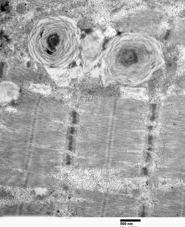 3B2 Hydroxychloroquine, muscle (Case 3) EM 009 - Copy