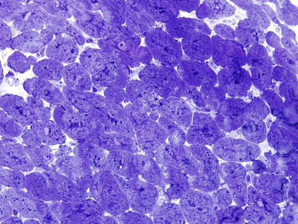 4A Hydroxychloroquine cardiomyopathy (Case 4) Plastic