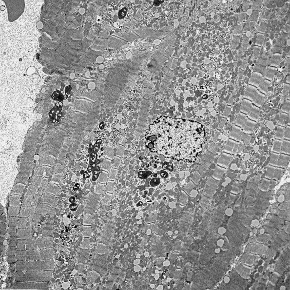 4B1 Hydroxychloroquine cardiomyopathy (Case 4) EM 030 - Copy