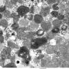 4B3 Hydroxychloroquine cardiomyopathy (Case 4) EM 003 - Copy