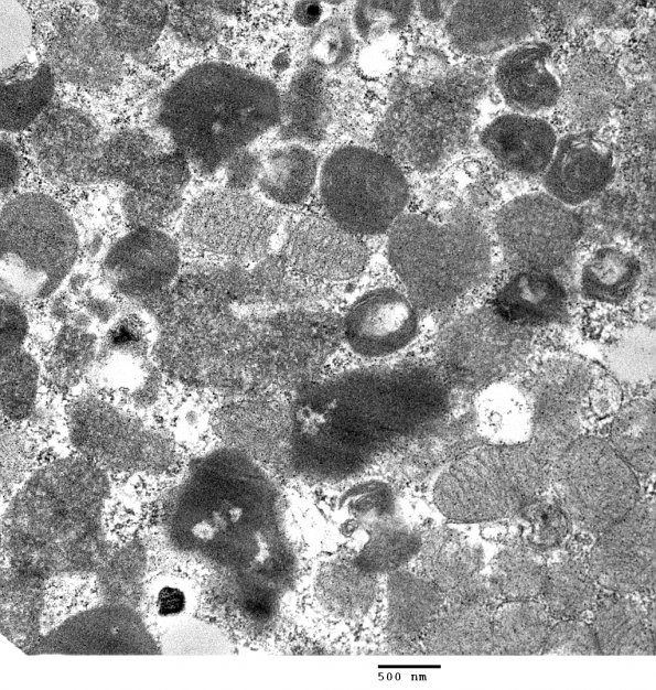 4B3 Hydroxychloroquine cardiomyopathy (Case 4) EM 003 - Copy